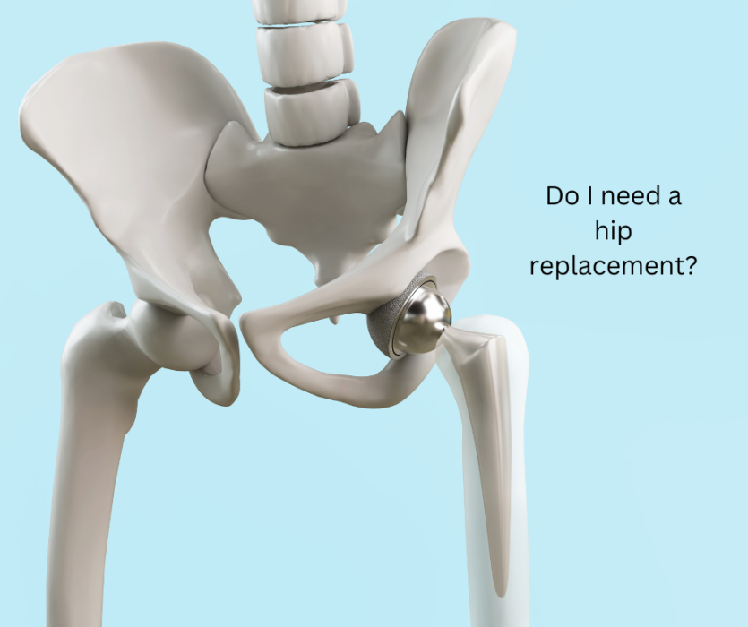 Hip Replacement. Do I need one, and when is the time right?