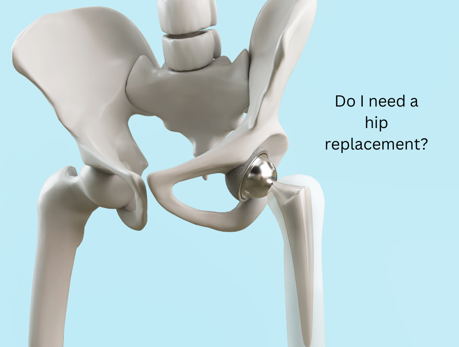 Hip Replacement. Do I need one, and when is the time right?